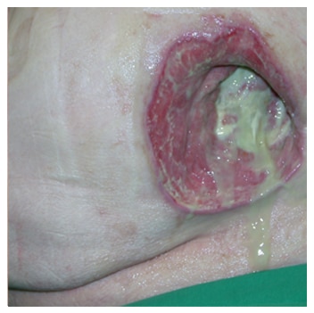 Wound infection