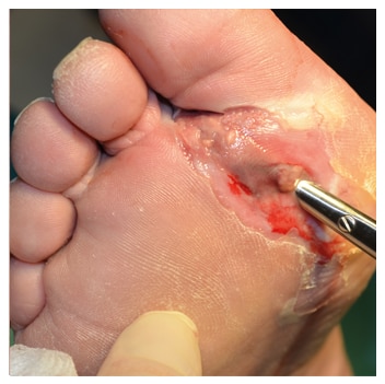 Diabetic foot ulcers