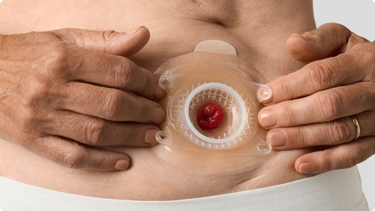 Many people living with a urostomy could benefit from a convex product