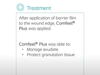 Treatment of a traumatic wound with a hydrocolloid. 