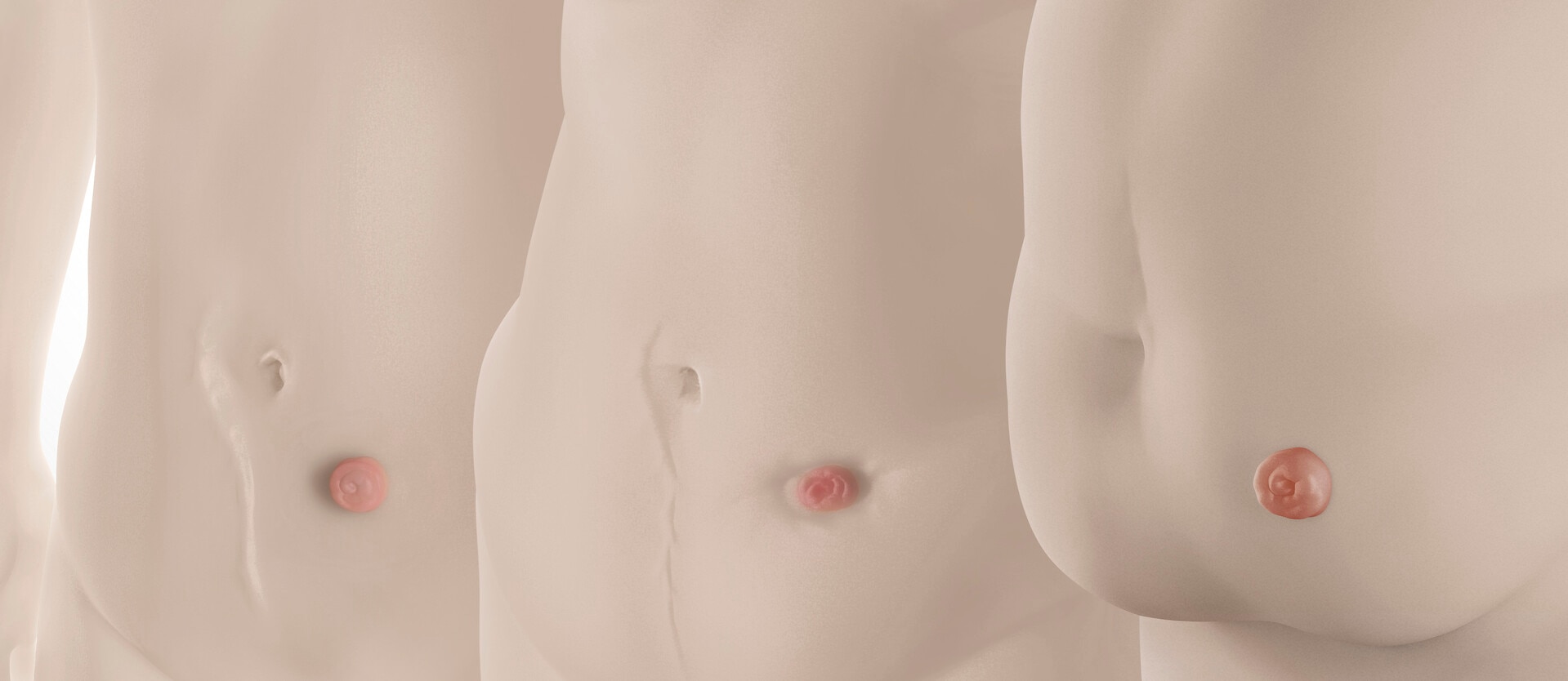 Peristomal body profile assessment tool
