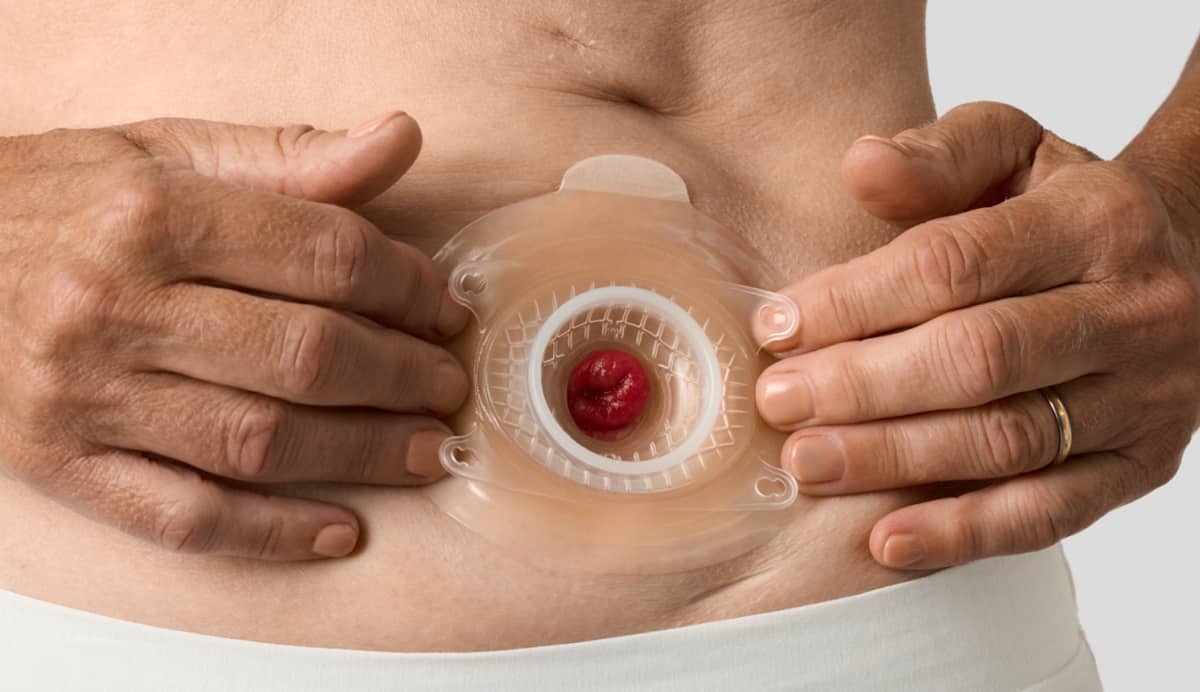 SenSura® Mio Convex