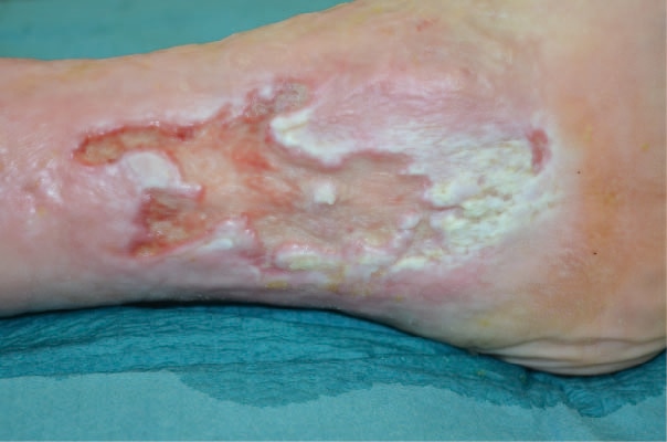 Treatment of a macerated Venous Leg Ulcer