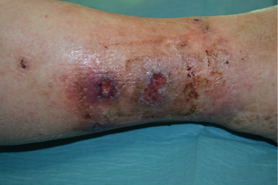 Treatment of an Arterial Leg Ulcer on lower leg
