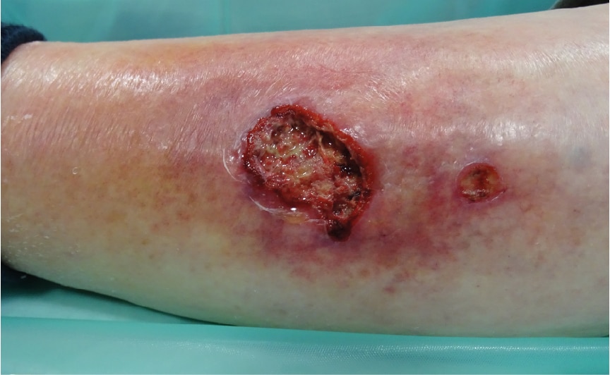 Infected traumatic wound on the lower leg