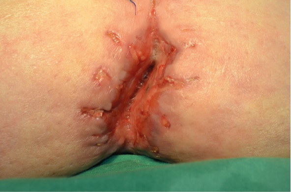 Treatment of a postoperative abdominal wound