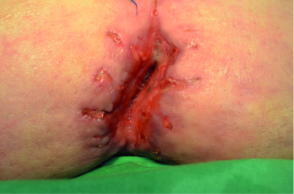 Treatment of a postoperative abdominal wound