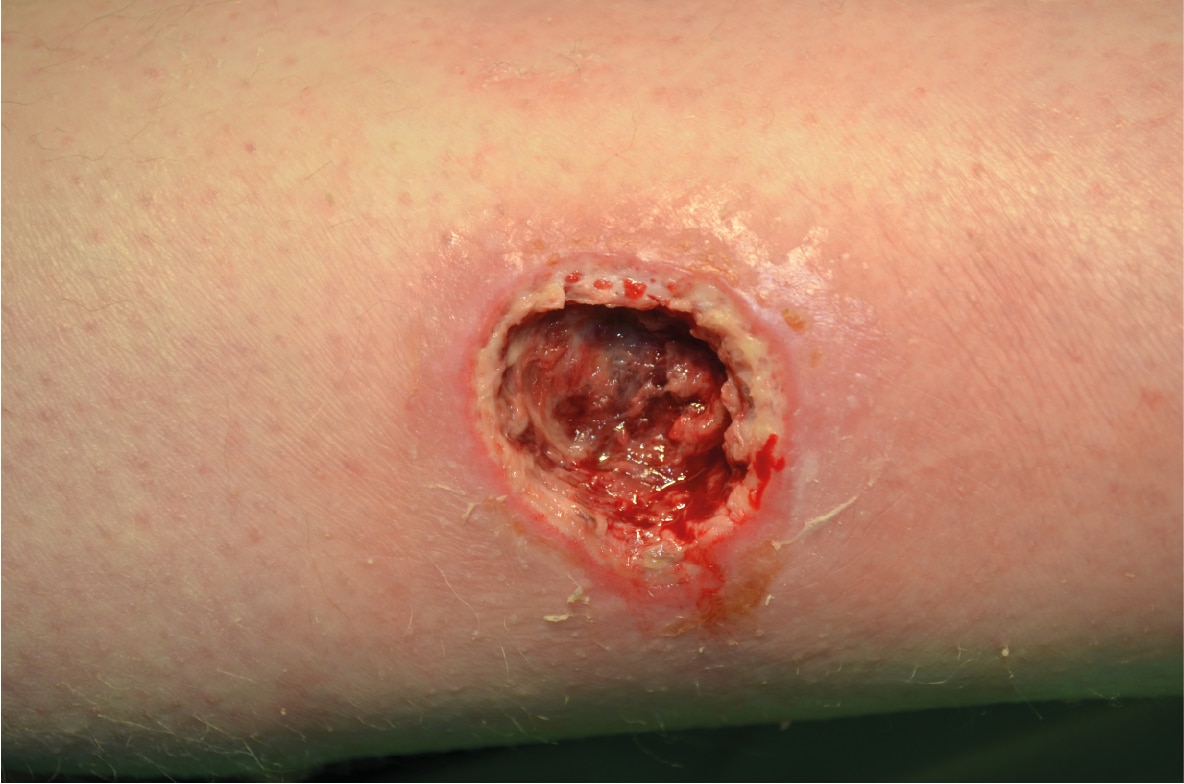 Pressure Ulcer on the right lower limb