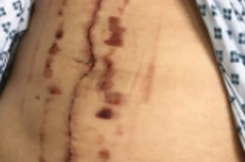 Incision wounds
