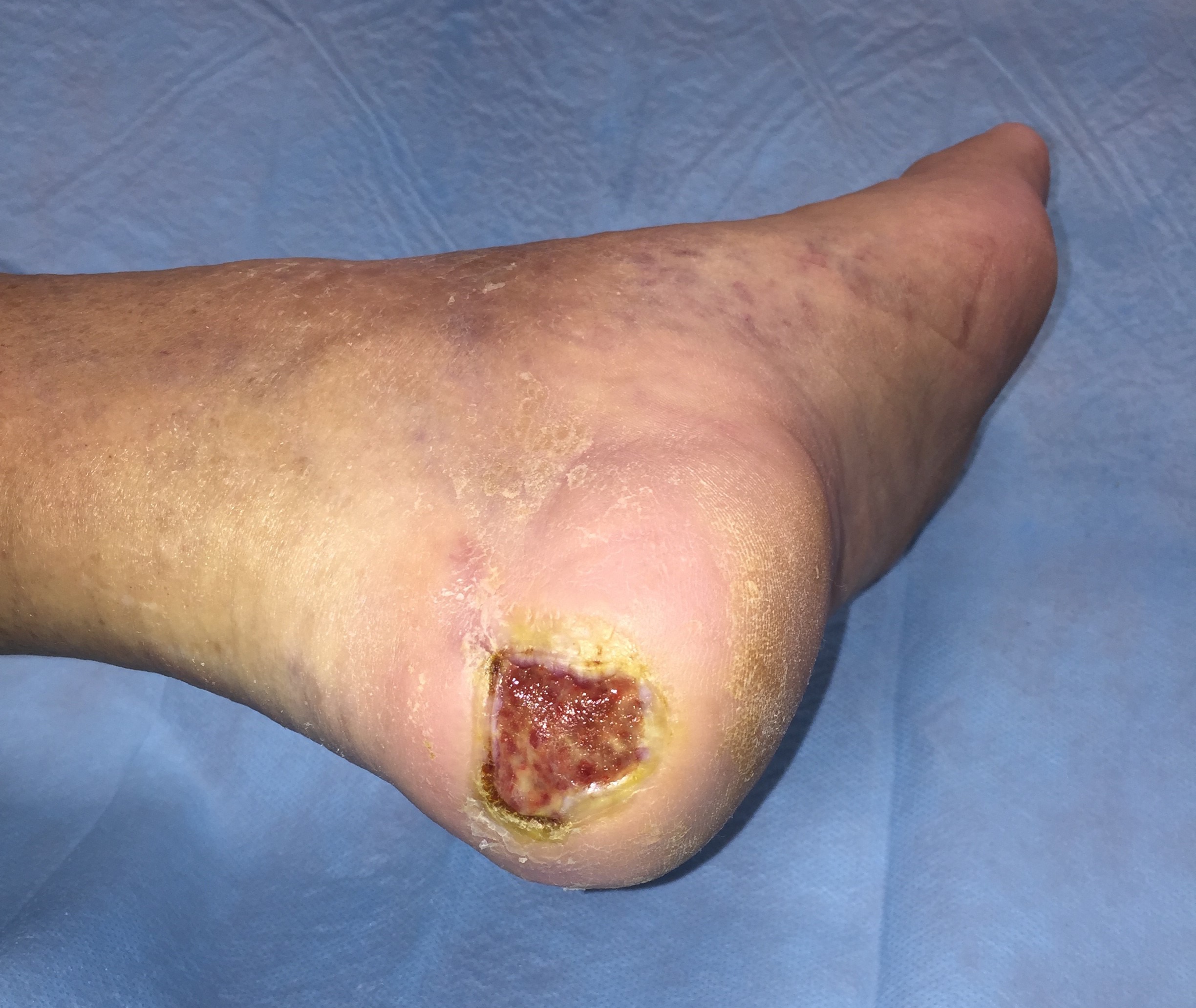 Treatment of a mildly infected diabetic foot ulcer on the heel