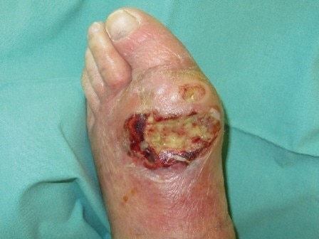 How to manage diabetic foot ulcers