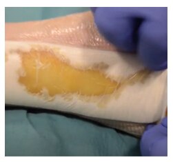 Clinical removal of Biatain Silicone