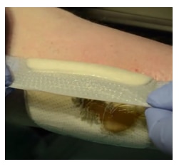 Biatain Silicone removal - Clinical example 2