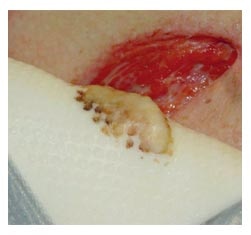 Conformability of Biatain® Silicone in clinical practice