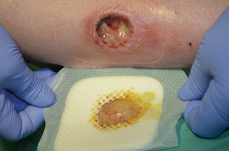 Management of pressure injuries