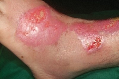 Wound Healing E-learning