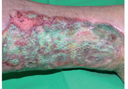 Example of wound with suspected biofilm