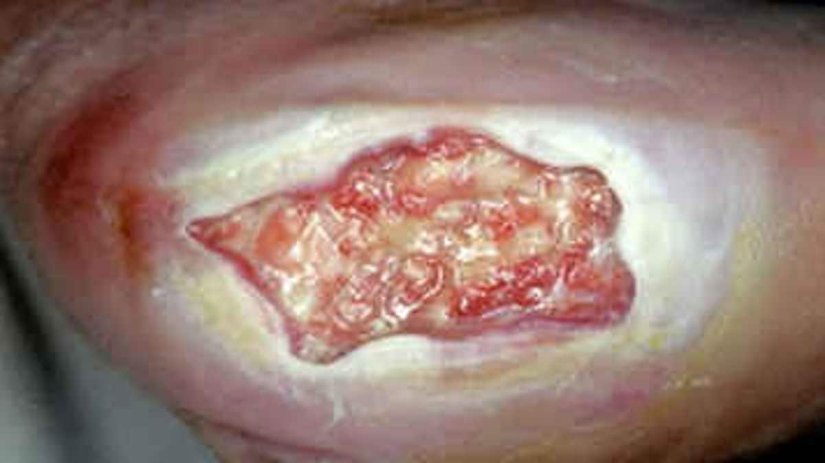 Antimicrobial Resistance