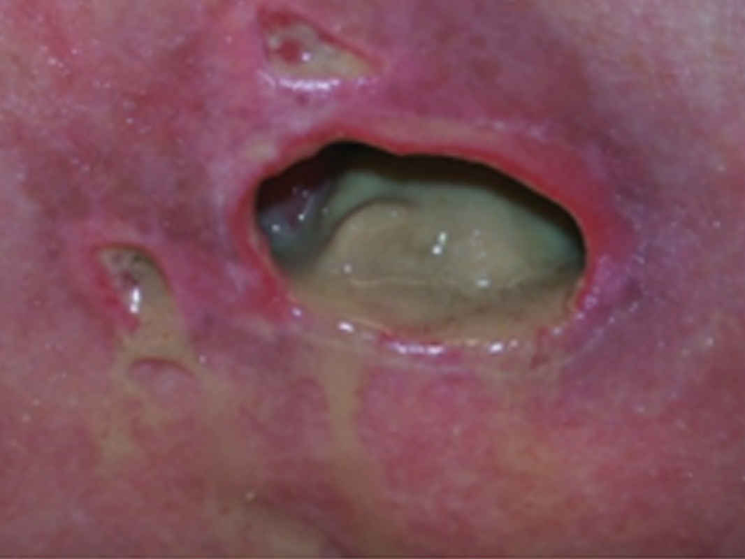 Seropurulent