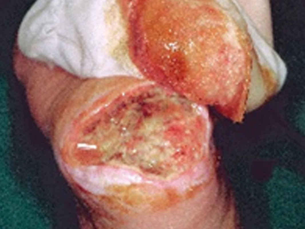 Serosanguineous