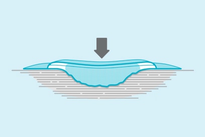 <h2>How to manage the gap & exudate</h2>