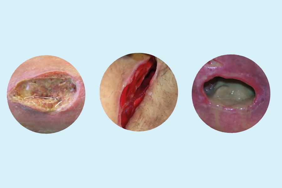 <h2>How to assess wound exudate</h2>