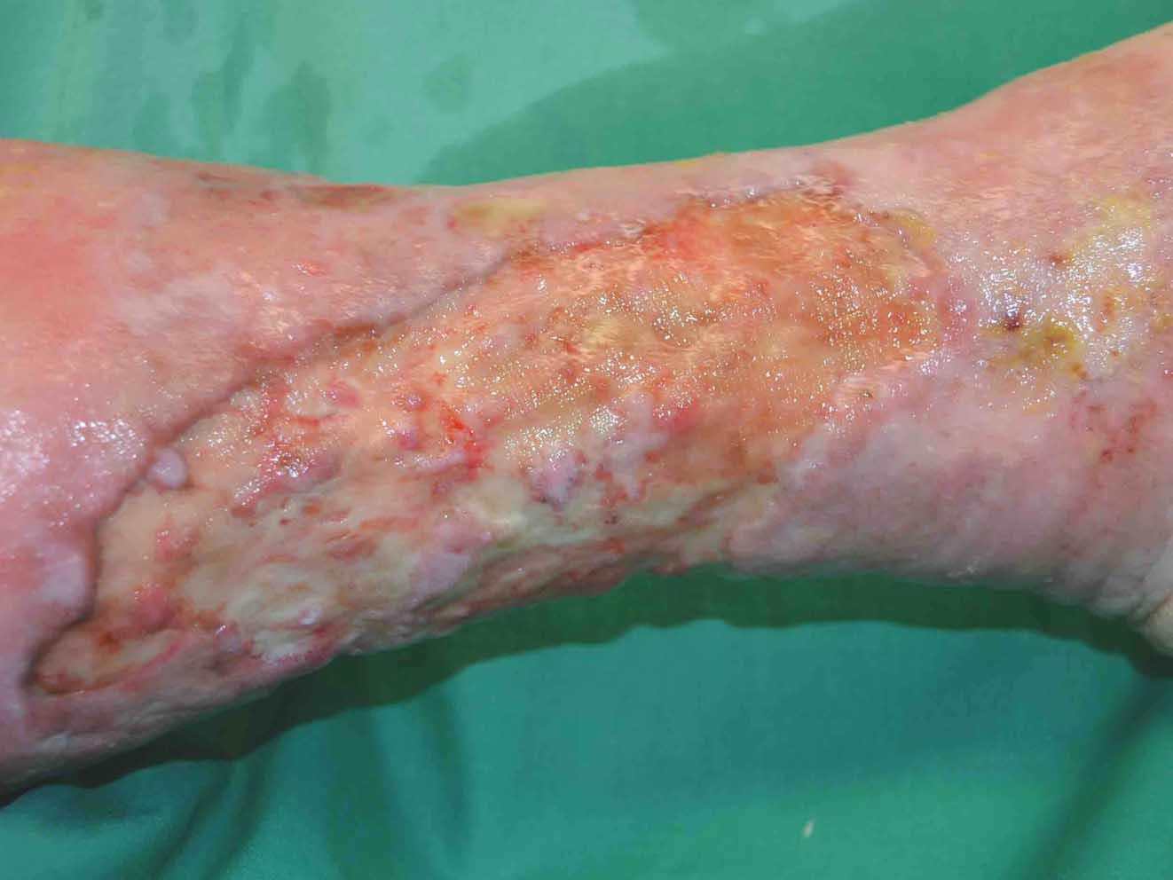 Antimicrobial Stewardship for infected wounds and biofilm