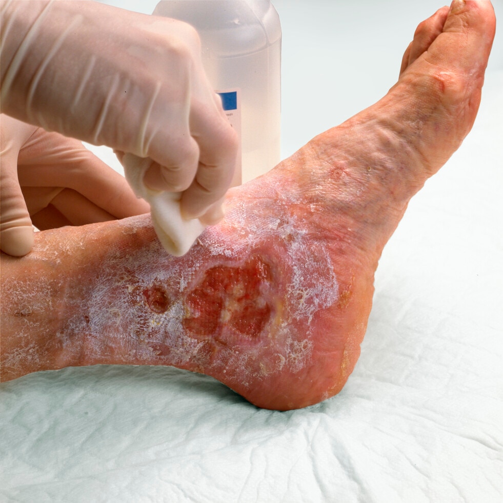 Advanced Wound Care Clinical videos