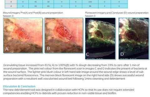 Results of a case series and satisfaction survey of a new wound cleansing and debridement pad in a management of biofilm