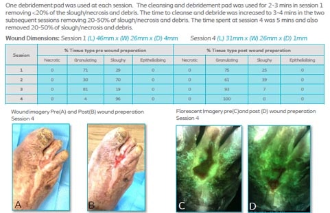 Results of a case series and satisfaction survey of a new wound cleansing and debridement pad