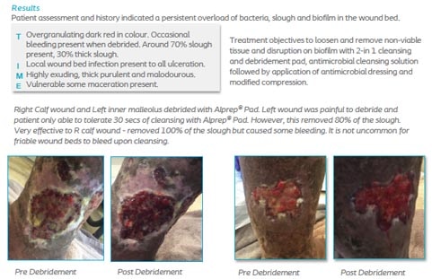 Treatment of suspected wound bed biofilm by mechanical debridement with 2 in 1 cleansing and debridement pad