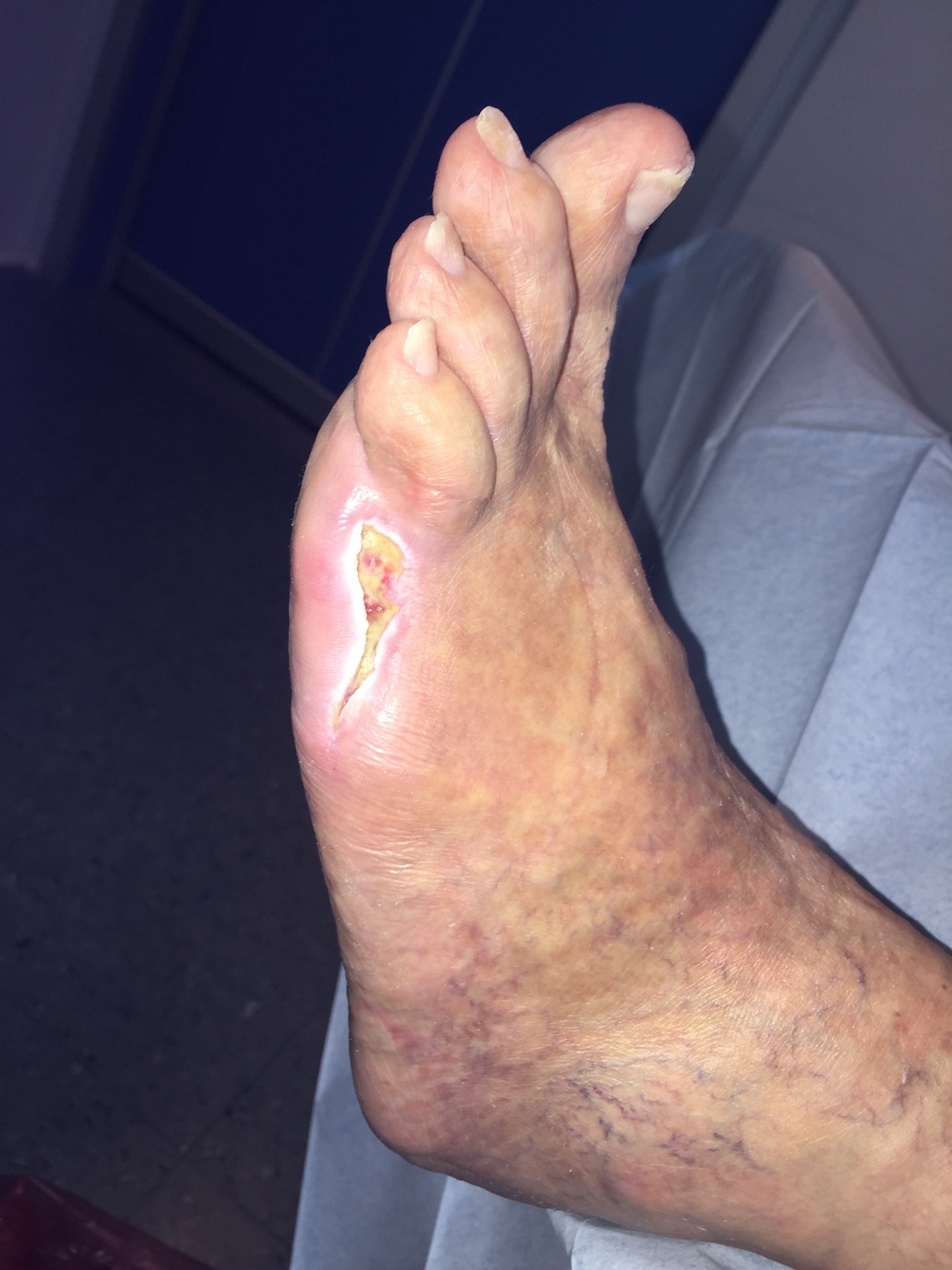 Treatment of a mildly infected diabetic foot ulcer on the toe
