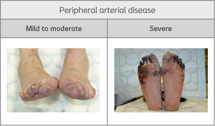 Peripheral arterial disease