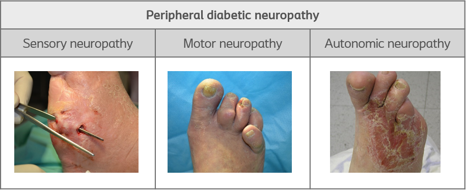 Peripheral diabetic neuropathy