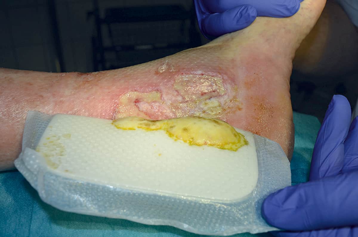 What is a silver dressing?