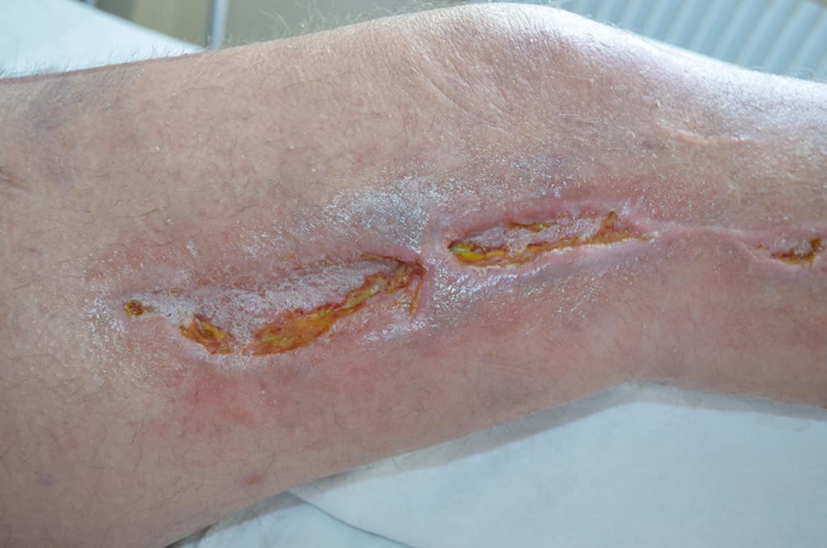 What are the benefits of silver dressings?