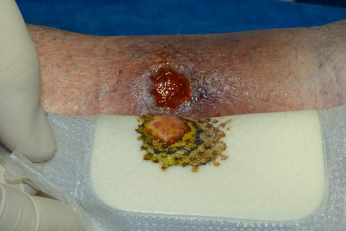 How to use silver dressings