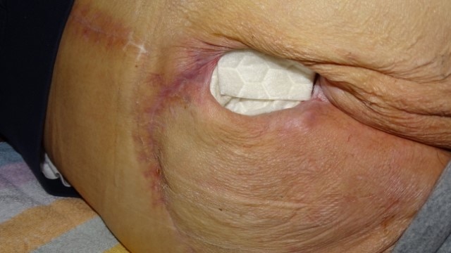 Sacral Pressure Wound with correct application of Biatain Fiber 