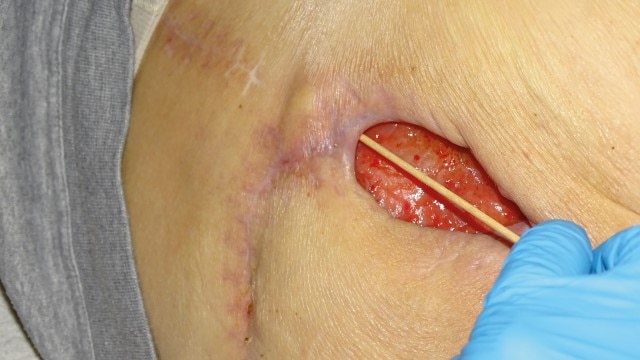 Sacral Wound with Undermining