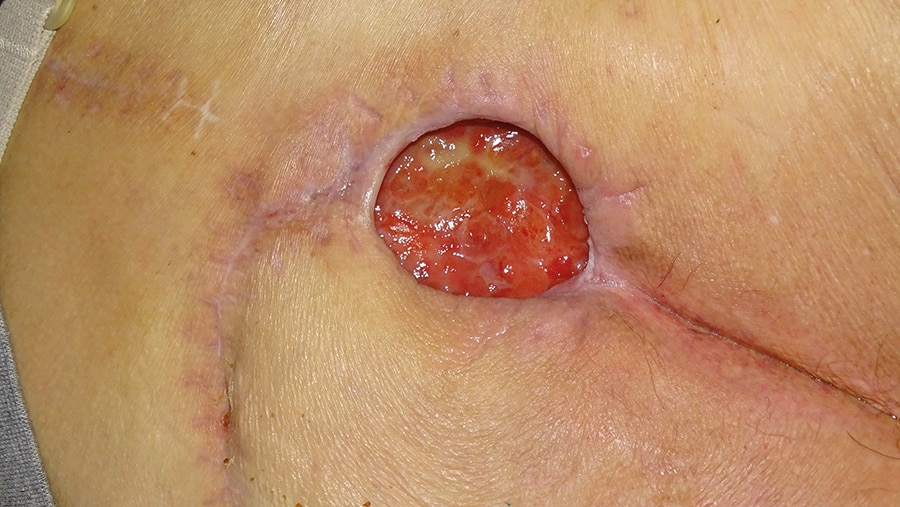 Sacral wound following dressing change