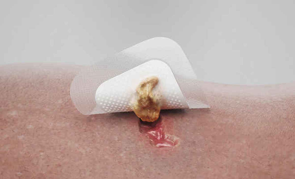 When a dressing doesn't fit perfectly, a Gap can form underneath it.