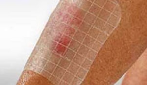 Monitor Wound Progression