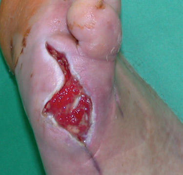 Granulating wound bed