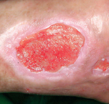 Healthy periwound skin