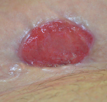 Healthy wound edge