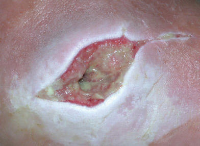 Wound maceration