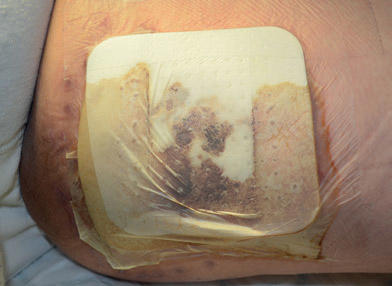 Assess what tissue types can be observed i.e. slough, necrosis.