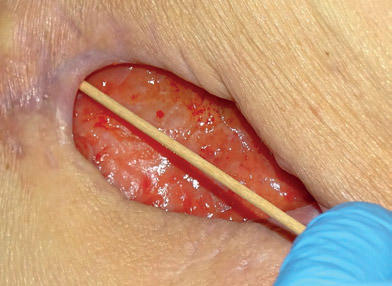Is the wound edge undermined?