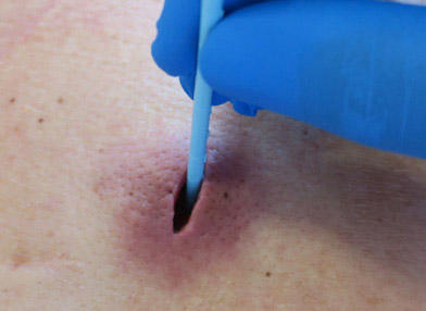 Measure the wound depth