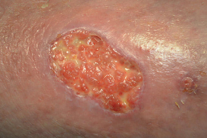 How to monitor patient and wound progression